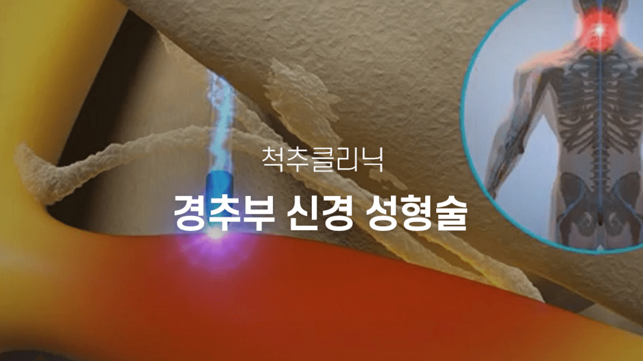 경추부신경성형술 사진