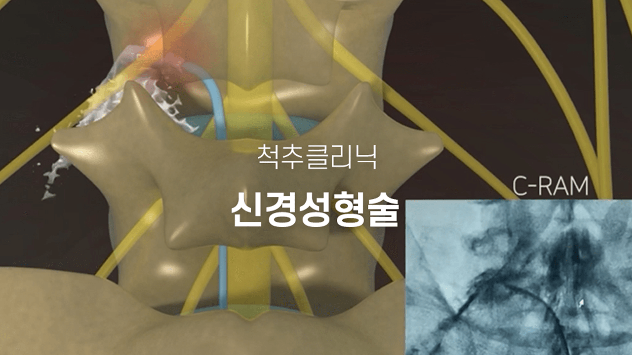 신경성형술 사진