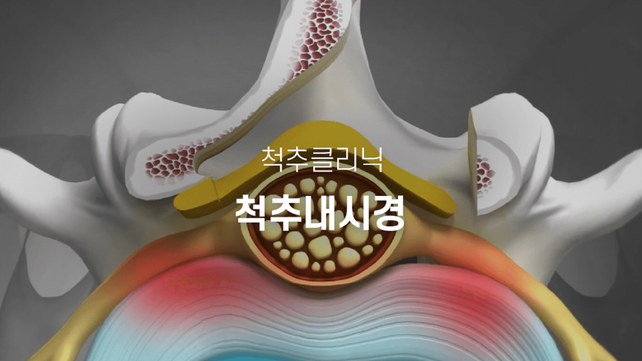 척추내시경 수술 사진